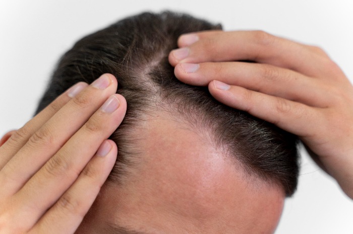 Biar Tidak Alami Kebotakan, Ini 5 Cara Cepat Tumbuhkan Rambut