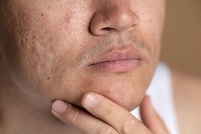 Tips dan Trik Ampuh Atasi Kulit Bruntusan, Lakukan Langkah Ini Agar Punya Wajah Glowing dan Mulus
