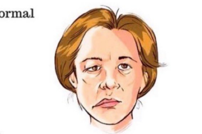 Kerap Disamakan dengan Stroke, Apa itu Bell's Palsy? Yuk Disimak