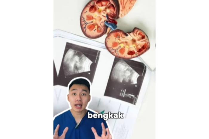 Yuk, Kurangi! dr Kevin Mak Ungkap Bahaya Mengonsumsi Minuman Sachet, Bisa Mengakibatkan Penyakit Ini