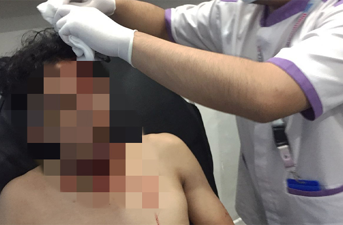 Aktivis GMNI Sukabumi Dibacok Orang Tak Dikenal